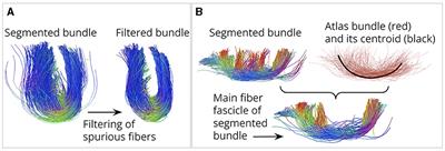 Short fiber bundle filtering and test-retest reproducibility of the Superficial White Matter